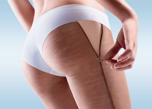 Biodermogenesi, nueva terapia regenerativa contra las estras