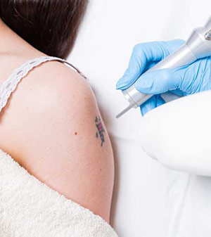 Riscos e formas de eliminao das tatuagens