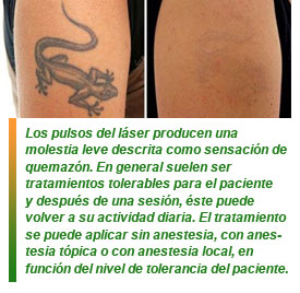 Eliminar tatuajes