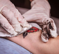 El láser es el único método testado clínicamente para eliminar los tatuajes