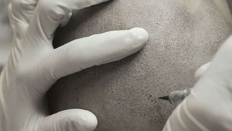 Micropigmentacin capilar, el efecto 'cabeza afeitada' ms natural