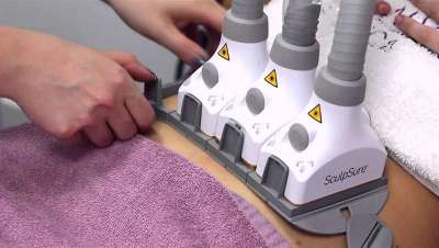 SculpSure, láser para la eliminación eficaz de la grasa localizada