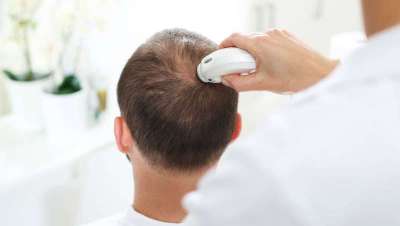 Infecciones y pérdida de zona donadora, problemas de los pacientes con implantes capilares hechos en Turquía