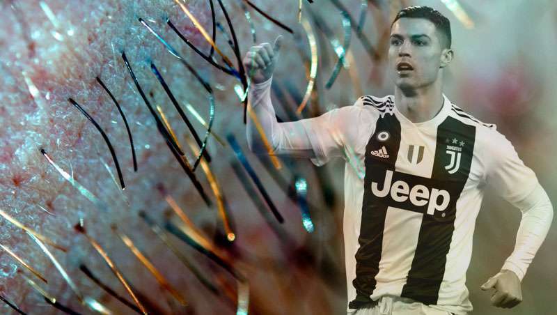 Turquia e CR7, o negócio do transplante capilar