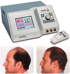 Indiba Deep Beauty, alternativa natural contra la cada del cabello