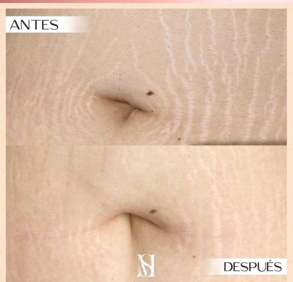 MICROPUNTURA BRASILEÑA/ADIOS ESTRIAS - BeautyMarket Estética: Anuncios