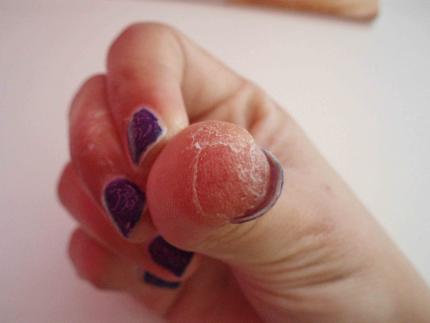 Picor y escozor en dedos y uñas - manicura uñas para profesionales
