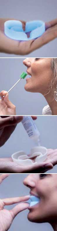 In Smile, sistema de blanqueamiento dental, intensivo y fotodinámico