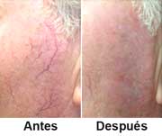 antes y después de tratamiento con Thermavein