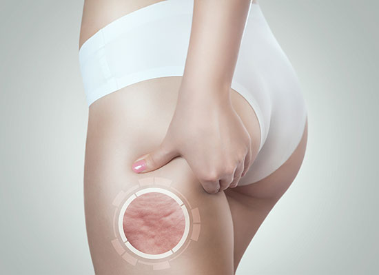 Celulitis: comienza la operación biquini