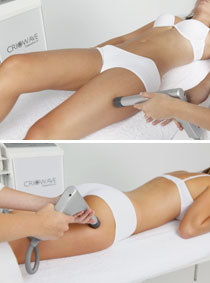Criowave termosalud