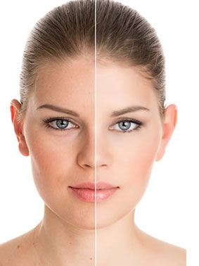 Electrolift, la alternativa a la inyección