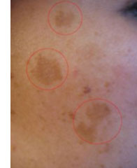 Lesiones pigmentarias benignas