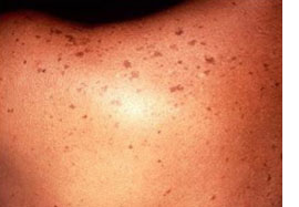 Lesiones pigmentarias benignas