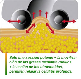 Aerosonic, Terapia subdérmica y Ultrasonidos para mejorar la figura