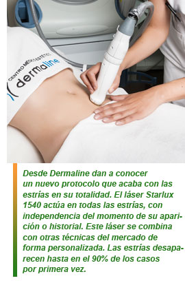 Las estrías y su tratamiento