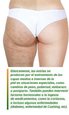 Las estrías y su tratamiento