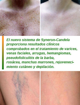 GentleMax Pro - Syneron-Candela