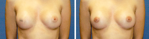 micropigmentacion areolas mamarias