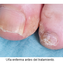 Antes del tratamiento con laser fox