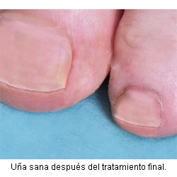 despues del tratamiento con laser fox