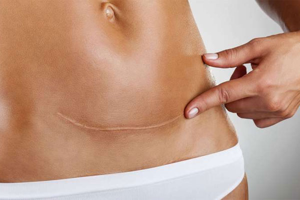 Cuidado de las cicatrices en verano