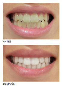 antes y despues de blanqueamiento dental