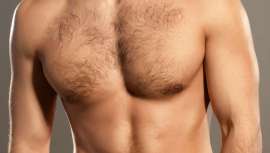 La ginecomastia es un aumento del tejido glandular mamario, que hay que diferenciar claramente del aumento de tamaño provocado por acumulación de tejido graso en la zona debido a incrementos de peso