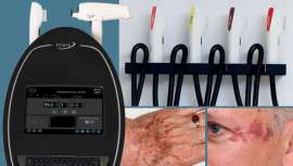 Combina el láser ND:YAG y aplicadores de IPL para adaptarse a las necesidades de cada tratamiento. Trata todo tipo de lesiones vasculares