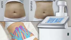 Una nueva generación de HIFU corporal de segunda generación combinan de forma simultánea, en el mismo manípulo, la  tecnología HIFU y la terapia de succión
