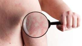 La Academia Española de Dermatología y Venereología dará una rueda de prensa, donde expertos dermatólogos reflexionarán sobre esta enfermedad que afecta cada vez a más personas en España