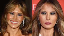 Donald Trump se proclama presidente de los Estados Unidos pero quien acapara todos los focos es su actual mujer, Melania Trump, exmodelo eslovaca. El doctor Fabio Vieira analiza con minuciosidad los cambios estéticos de la nueva primera dama