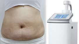 Es el primer sistema no invasivo de remodelación corporal que utiliza pulsos específicos de ultrasonidos, en combinación con la terapia de succión de forma simultánea. Con ello se eliminan las células adiposas de forma selectiva y totalmente indolora