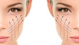 El tratamiento está especialmente indicado para mujeres de 35 a 45 años o en casos de flacidez moderada en la zona nasolabial