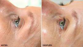 El centro Rocío Bosque Estética recomienda esta técnica para conseguir una piel más joven y radiante durante las fiestas