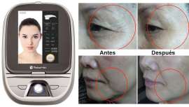 Indesa lanza al mercado su equipo Ulverin, ultrasonido focalizado de alta intensidad (HIFU) que desencadena una respuesta general debajo de la piel, activando un rápido proceso de regeneración