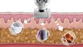 Los cabezales del tratamiento patentado de LPG, de la técnica endermologie, estimulan suavemente la piel para reactivar de forma natural la actividad celular latente, sin dolor y sin efectos secundarios