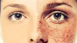 Entre las peticiones más populares en los gabinetes de dermatología estética se encuentra la de acabar con el melasma. El ácido tranexámico podría ser la solución definitiva para combatir las manchas más rebeldes y extendidas