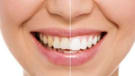 El blanqueamiento es un tratamiento odontológico que debe llevarse a cabo con la supervisión de un dentista. Solo se puede realizar en una boca sana, sin caries ni enfermedades periodontales