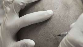 A simple vista, esta técnica simula el nacimiento del pelo en el cuero cabelludo. Es apta para cualquier persona, sobre todo aquellas que sufren alopecia y no se pueden someter a microinjertos e intervenciones capilares similares