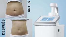 Es el tratamiento de reducción de grasa más cómodo e indoloro, donde la eliminación de la grasa liberada es de forma natural