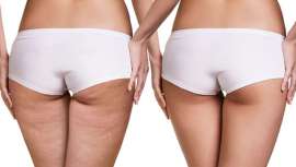 Ten Image Professional aconseja sobre cómo acabar con la celulitis gracias a diversas técnicas, masajes, cremas y geles