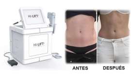 La tecnología de ultrasonidos focalizados de alta intensidad permite al profesional concentrar toda la energía en los puntos a tratar 