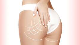 Los hilos tensores PDO se han convertido en la solución más idónea para lograr una retaguardia de infarto en muy poco tiempo