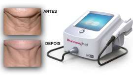 Trata-se de uma revolucionária tecnologia de segunda geração de HIFU facial, com sistemas de controlo eletrónico, que provêm dos lasers para a procura da máxima eficácia com o mínimo incómodo