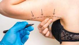 Esta intervención solo está recomendada para personas con un exceso de piel y grasa muy considerables, ya que deja una inevitable y antiestética cicatriz, difícil de disimular