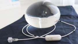 Este nuevo tratamiento contra la obesidad de la Clínica Tufet, ayuda a pacientes con sobrepeso a perder hasta un 20-50% del exceso de su peso sin necesidad de cirugía, endoscopia ni anestesia