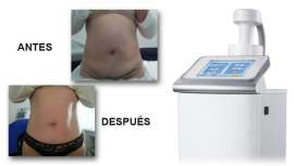 El Grupo Slyou presenta esta tecnología de segunda generación de ultrasonidos focalizados pulsados para reducir la grasa localizada de forma permanente