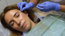 Este tratamiento médico-estético, mínimamente invasivo, corrige eficazmente la flacidez y el descolgamiento de la piel