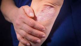 El gen TREX2 es responsable de la respuesta inflamatoria que se desencadena durante la psoriasis. Así lo identifica la investigación publicada por la revista científica Journal of Investigative Dermatology, descubrimiento vital para su cura